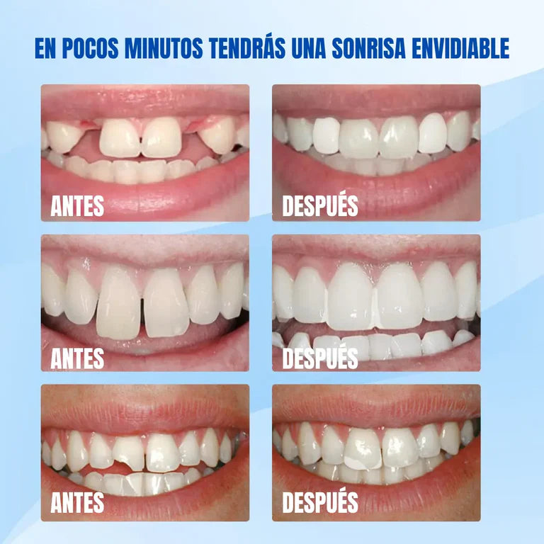 Resina Dental Moldeable: Sonrie Sin Miedo 😁